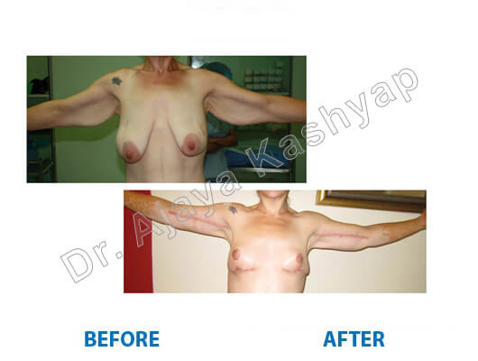 brachioplasty lift surgery in Delhi